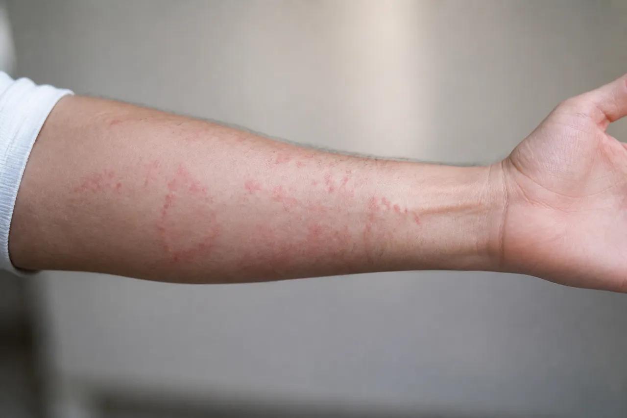 Réaction allergique aux lentilles corail
